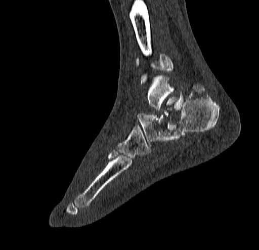 Calcaneal fracture - Sanders type 4 (Radiopaedia 90179-107370 Sagittal bone window 62).jpg
