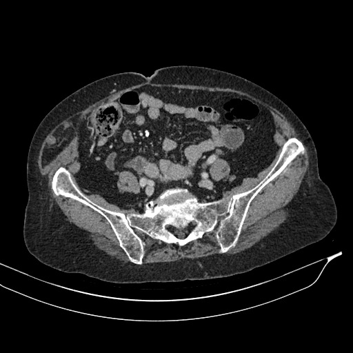 Calcified adrenal glands and Spigelian hernia (Radiopaedia 49741-54988 A 166).jpg