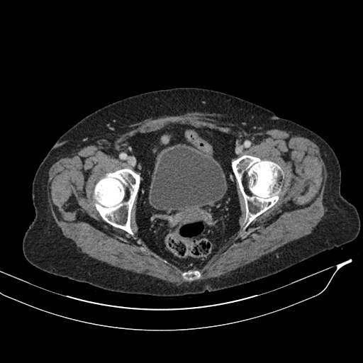 Calcified adrenal glands and Spigelian hernia (Radiopaedia 49741-54988 A 224).jpg
