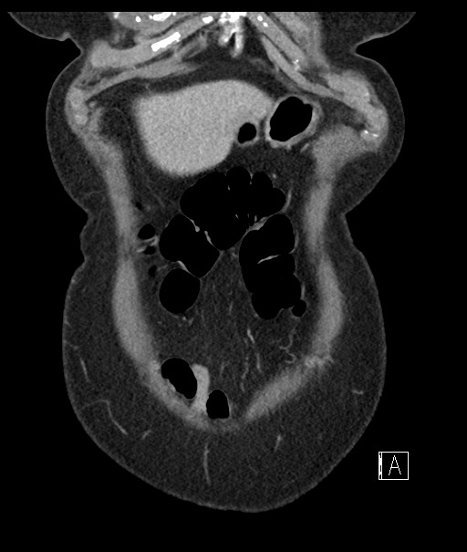 Calcified adrenal glands and Spigelian hernia (Radiopaedia 49741-54988 B 15).jpg