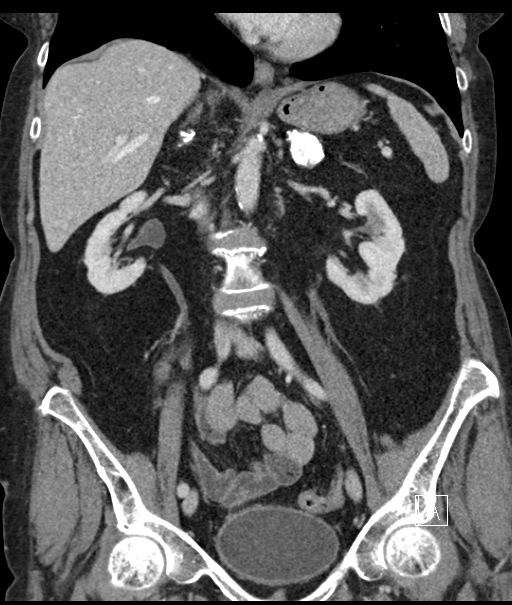 Calcified adrenal glands and Spigelian hernia (Radiopaedia 49741-54988 B 59).jpg
