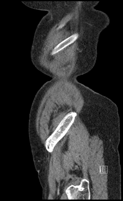 Calcified adrenal glands and Spigelian hernia (Radiopaedia 49741-54988 C 12).jpg