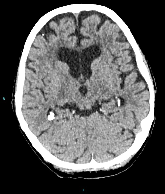 Calcified cerebral emboli from left ventricular thrombus (Radiopaedia 84420-99758 Axial non-contrast 55).jpg