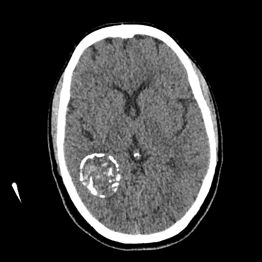 Calcified cerebral hydatid cyst (Radiopaedia 65603-74717 Axial non-contrast 34).jpg