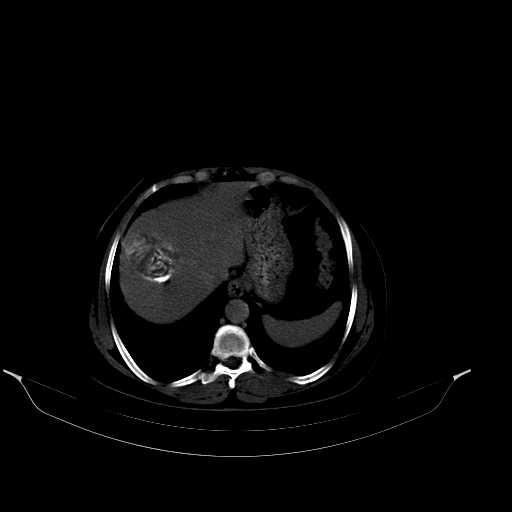 File:Calcified hydatid cyst of the liver (Radiopaedia 21212-21112 Axial bone window 10).jpg