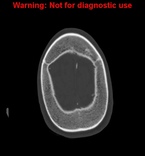 File:Calvarial thickening from chronic shunting (Radiopaedia 60079-67637 Axial bone window 165).jpg