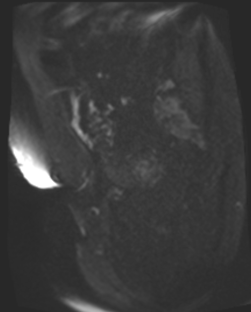 Cancer cervix - stage IIb (Radiopaedia 75411-86615 Sagittal DWI 68).jpg