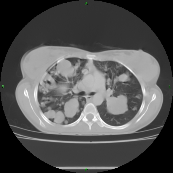 File:Cannon ball metastases - synovial sarcoma (Radiopaedia 26135-26271 Axial lung window 15).jpg