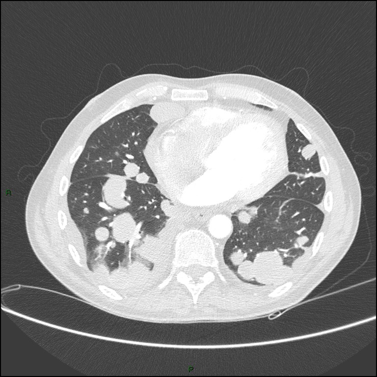 Cannonball metastases (Radiopaedia 82110-96150 Axial lung window 132).jpg