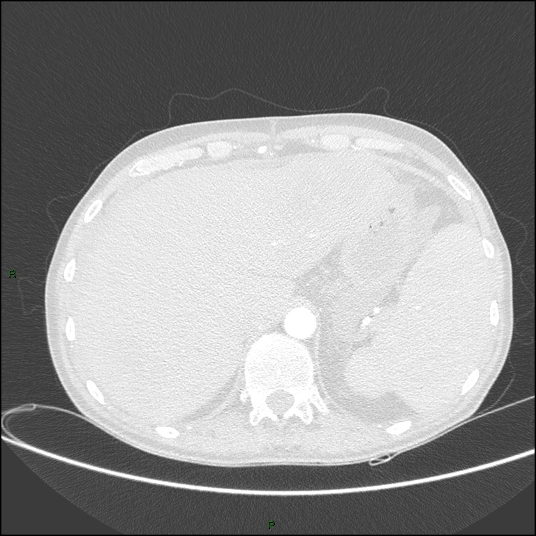 Cannonball metastases (Radiopaedia 82110-96150 Axial lung window 183).jpg