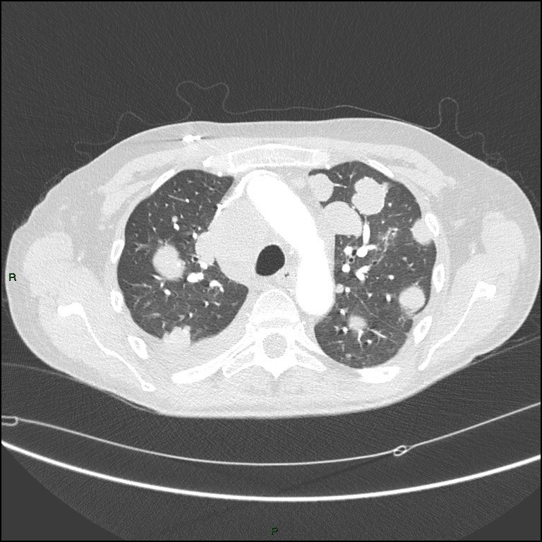Cannonball metastases (Radiopaedia 82110-96150 Axial lung window 67).jpg