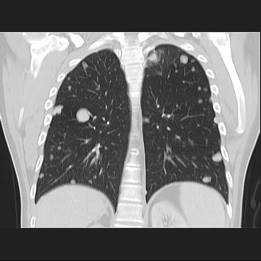 File:Cannonball pulmonary metastases (Radiopaedia 67684-77101 C 17).jpg