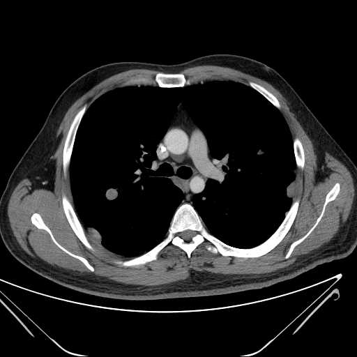 File:Cannonball pulmonary metastases (Radiopaedia 67684-77101 D 112).jpg