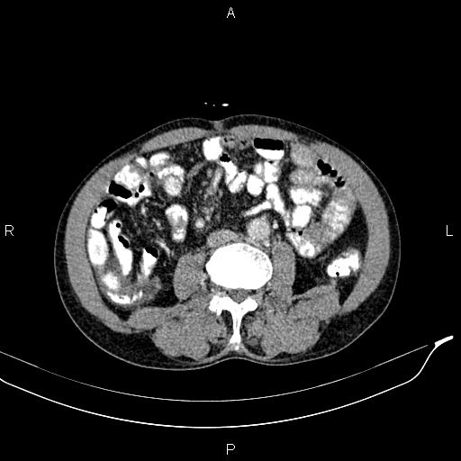 Caput medusae sign - portal hypertension (Radiopaedia 64007-72759 A 54).jpg