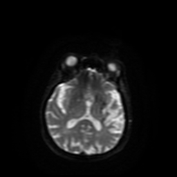 Carcinoma ex-pleomorphic adenoma of parotid (Radiopaedia 28383-28627 Ax DWI B-500 GE 36).jpg