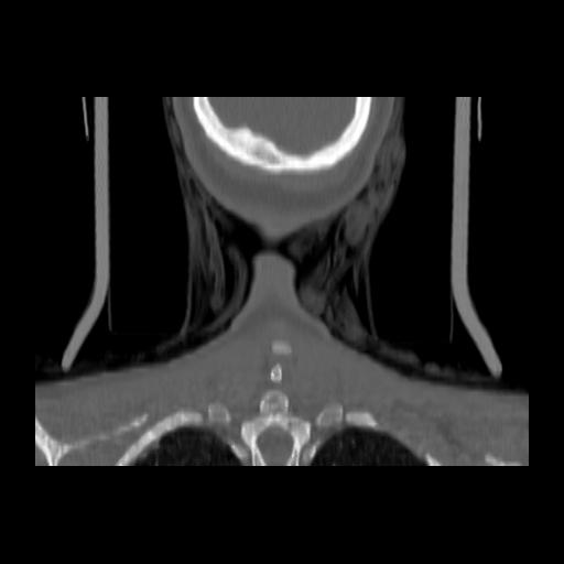 Carcinoma of the maxillary antrum (Radiopaedia 53805-59888 Coronal bone window 149).jpg