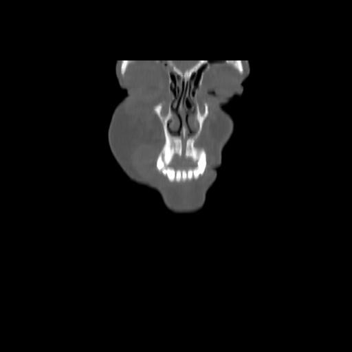 Carcinoma of the maxillary antrum (Radiopaedia 53805-59888 Coronal bone window 18).jpg