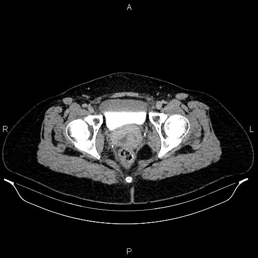 File:Carcinoma of uterine cervix (Radiopaedia 85861-101700 Axial C+ delayed 87).jpg