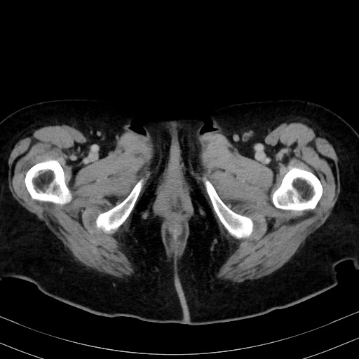 Carcinosarcoma (Radiopaedia 70401-80503 A 76).jpg