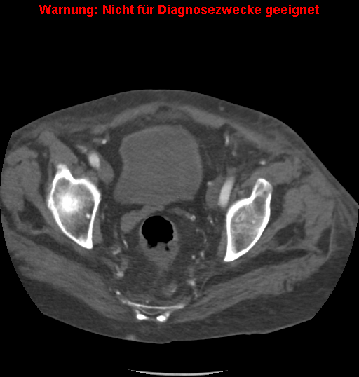 File:Cardiac perforation following transcatheter aortic valve implantation (Radiopaedia 23714-23863 B 1).png