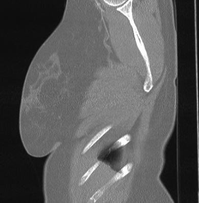 File:Cardiac sarcoidosis (Radiopaedia 74548-85534 Sagittal lung window 88).jpg