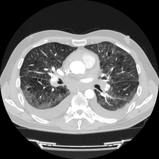 Cardiac tamponade (Radiopaedia 78607-91368 Axial lung window 42).jpg