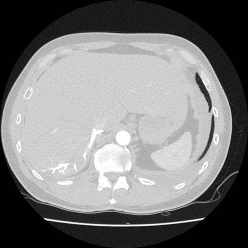 File:Cardiac tamponade (Radiopaedia 78607-91368 Axial lung window 91).jpg