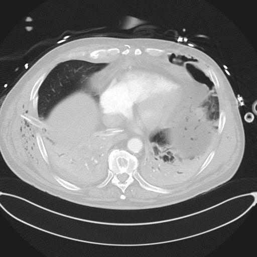 Cardiac trauma (Radiopaedia 32874-33858 Axial lung window 40).jpg