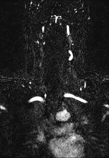Carotid artery dissection (Radiopaedia 28441-28689 Coronal MRA 50).jpg