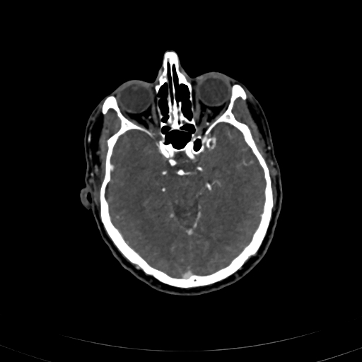 File:Carotid body tumor (Radiopaedia 83615-98727 A 4).jpg