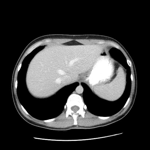 Castleman disease with fibrous pseudotumor in the abdomen (Radiopaedia 77296-89373 A 19).jpg