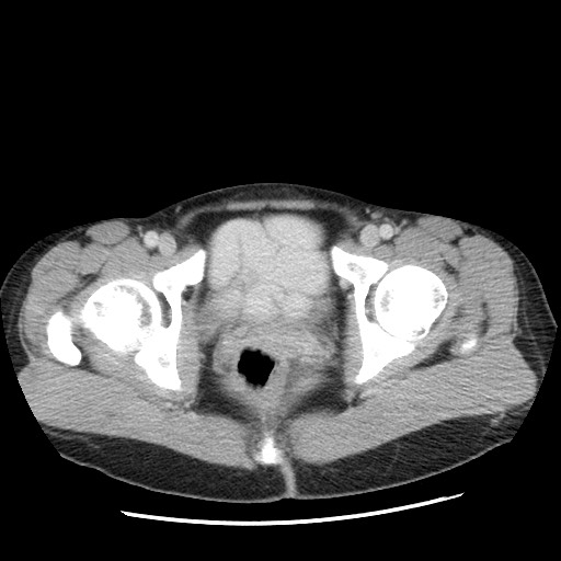 File:Castleman disease with fibrous pseudotumor in the abdomen (Radiopaedia 77296-89373 Axial 102).jpg