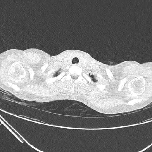 Catamenial pneumothorax (Radiopaedia 27946-28197 lung window 18).jpg