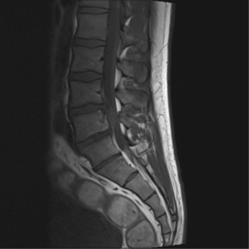 File:Cauda equina syndrome (Radiopaedia 53615-59672 Axial T1 8).png