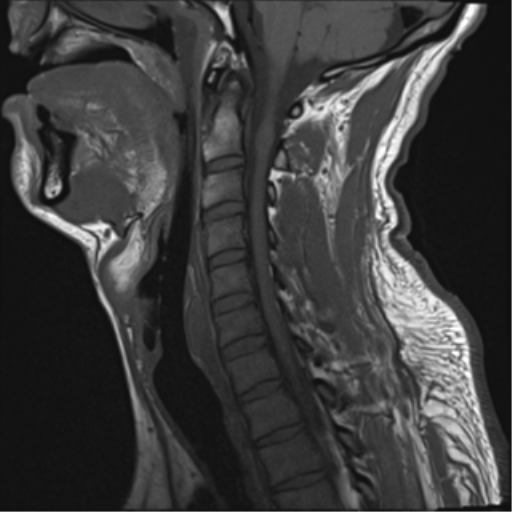File:Cavernoma of cervical cord (Radiopaedia 50838-56347 Sagittal T1 9).png