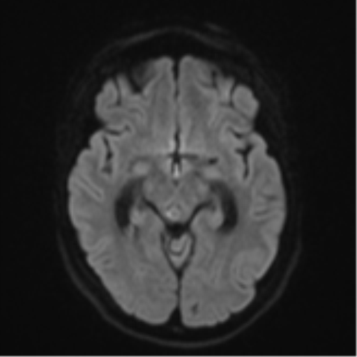 File:Cavernoma with bleed - midbrain (Radiopaedia 54546-60774 Axial DWI 39).png