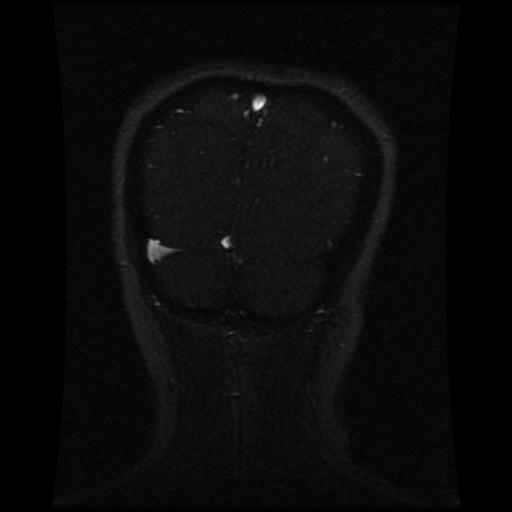 File:Cavernoma with developmental venous anomaly (Radiopaedia 22470-22507 MRV 34).jpg