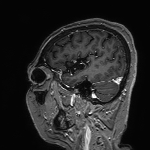 Cavernous hemangioma of the cerebellar falx (Radiopaedia 73025-83724 Sagittal T1 C+ 44).jpg