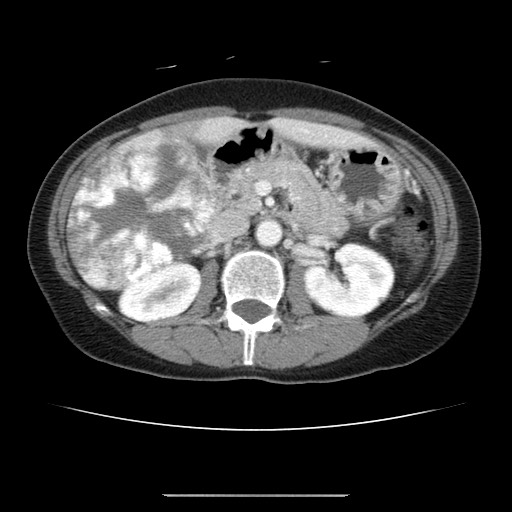 Cavernous hepatic hemangioma (Radiopaedia 75441-86667 B 45).jpg