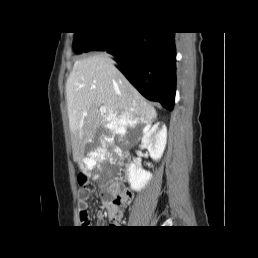 Cavernous hepatic hemangioma (Radiopaedia 75441-86667 D 65).jpg