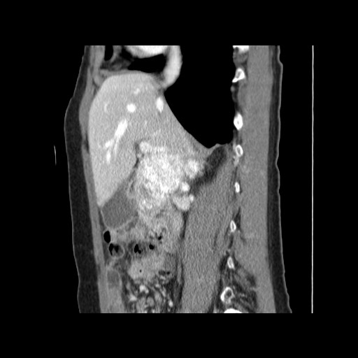 Cavernous hepatic hemangioma (Radiopaedia 75441-86667 D 76).jpg