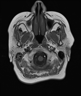 File:Cavernous sinus meningioma (Radiopaedia 63682-72367 Axial T1 2).jpg