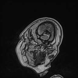 Cavernous sinus meningioma (Radiopaedia 63682-72367 Sagittal T1 C+ 28).jpg