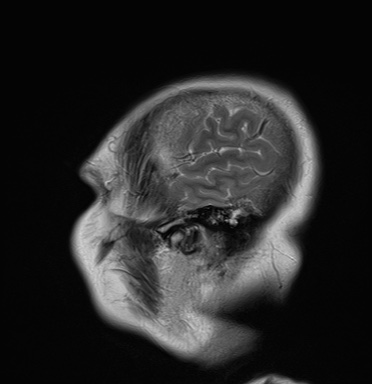 File:Cavernous sinus meningioma (Radiopaedia 63682-72367 Sagittal T2 19).jpg