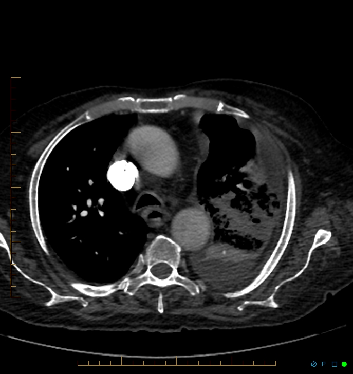 Cavitating pulmonary infarction (Radiopaedia 54634-60849 Axial C+ CTPA 20).jpg