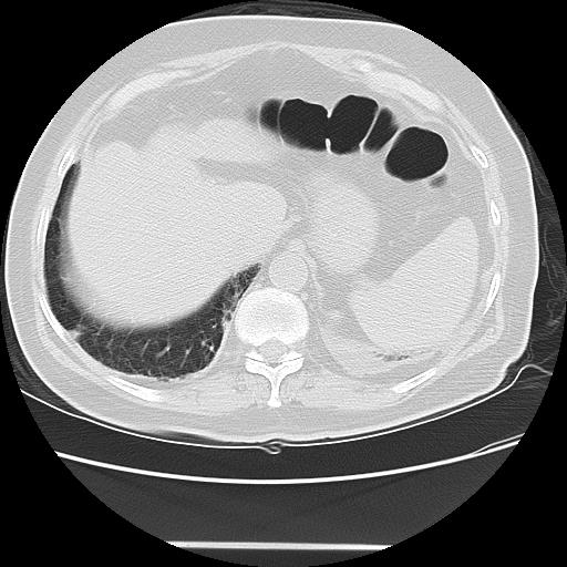 Cavitating pulmonary metastases (Radiopaedia 89545-106544 Axial lung window 50).jpg