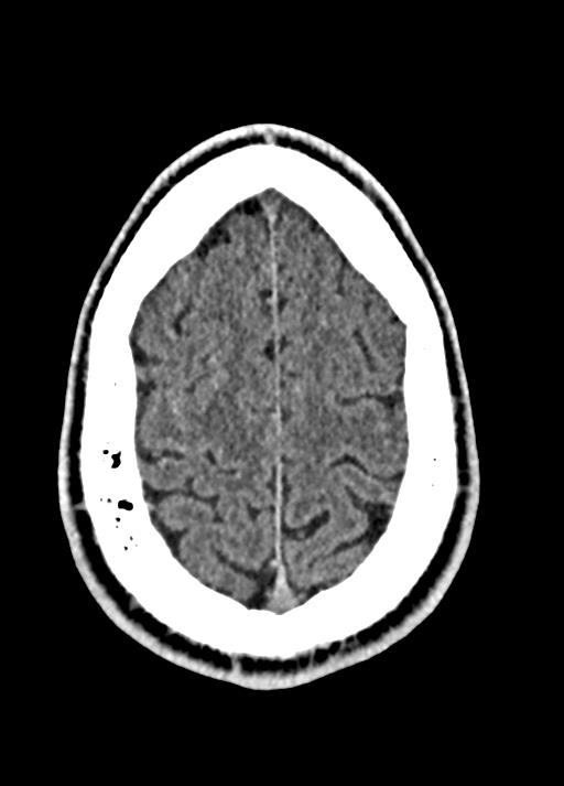 Cavum septum pellucidum and cavum vergae (Radiopaedia 77797-90060 Axial Brain Window 88).jpg
