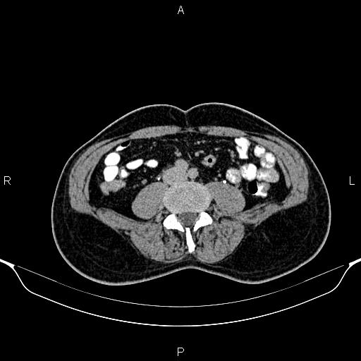 Cecal adenocarcinoma (Radiopaedia 85324-100916 Axial C+ delayed 60).jpg