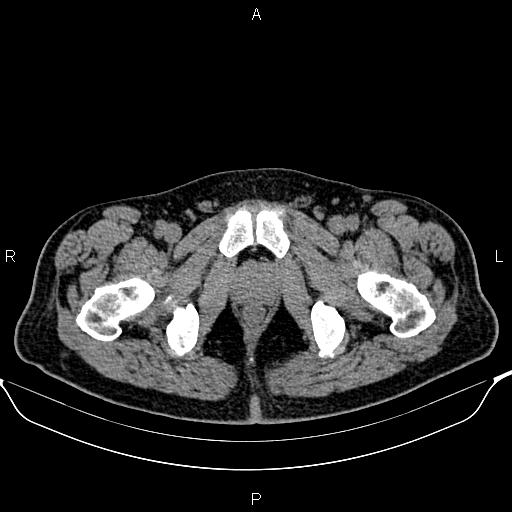 Cecal adenocarcinoma (Radiopaedia 85324-100916 Axial non-contrast 102).jpg