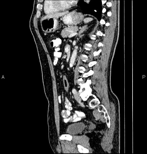 Cecal adenocarcinoma (Radiopaedia 85324-100916 E 55).jpg